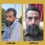 کاشت مو حرفه ای در بیمارستان خصوصی در شیراز