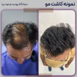 کاشت مو طبیعی در تهران (پایتخت ایران)