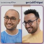 کاشت مو طبیعی در تهران (پایتخت ایران)