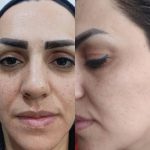 جوانسازی صورت