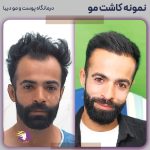 کاشت مو طبیعی در تهران (پایتخت ایران)