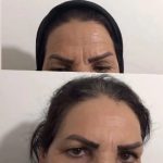 جوانسازی صورت