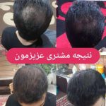 کاشت مو در منزل در کمترین زمان