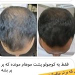 کاشت مو در منزل در کمترین زمان